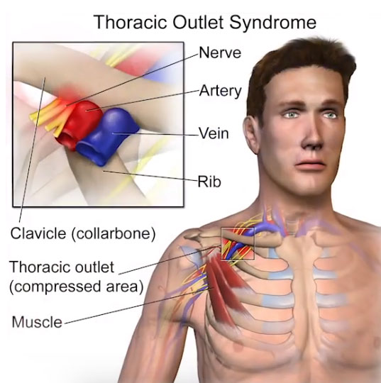 Thoracic Outlet Syndrome | Richard Sanders Institute